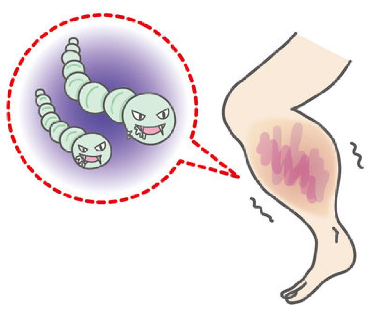 人食いバクテリアの現状と予防 その1