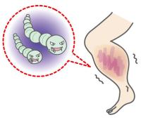 人食いバクテリアの現状と予防