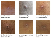 エムポックス(エムポックシー:サル痘)についての特集記事